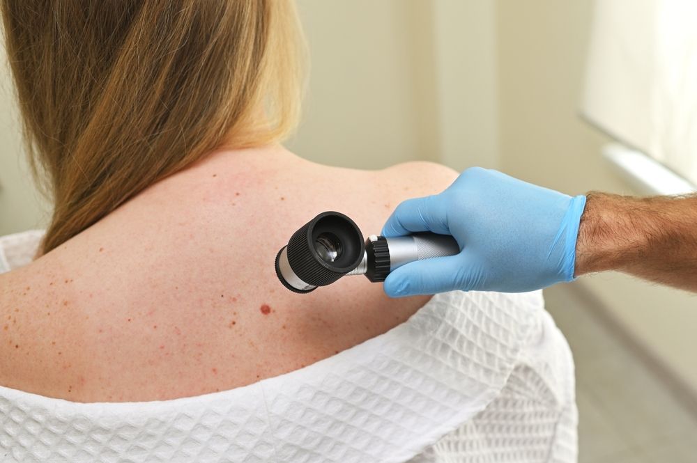 A,Dermatologist,Oncologist,Uses,A,Dermatoscope,To,Examine,Moles,And
A melanoma megelőzésére kiemelten kell figyelni